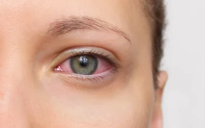 Red Eyes: Causes & When to See a Doctor